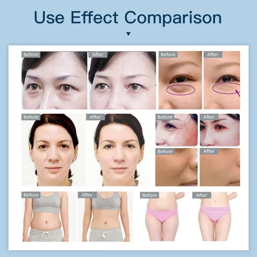 Machine Cavitation Sous Vide Ultrasonique, RadiofréQuence 40K Rf - Machine De Sculpture Corporelle 4 En 1 Pour Resserrer La Peau, Machine De Beauté Du Visage, Pour Le Visage, Les Bras